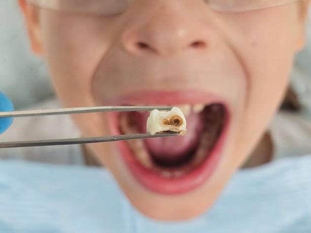 Best Emergency Tooth Extraction in Archer, FL